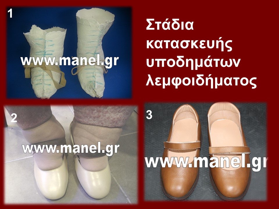 Χειροποίητα ορθοπεδικά παπούτσια - υποδήματα για λεμφοίδημα και σφυροδακτυλίια